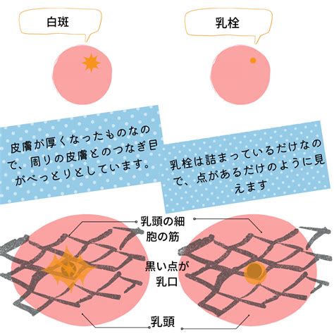 乳首に白い|【医師監修】乳腺炎の原因にもなる白斑、乳口炎の対処法と。